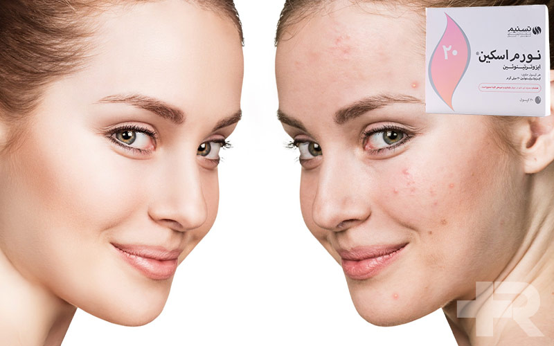 کپسول نورم اسکین 20